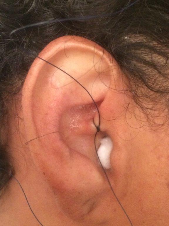 Auriculomédecine - Omnipraticien Richer - Saint Denis de La Réunion