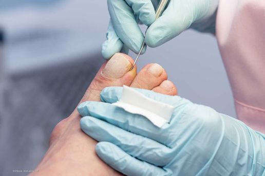 Der Zeh einer Person wird von einer Person mit Handschuhen und einem Werkzeug behandelt. Fokus auf Zeh und Händen.