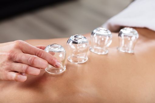 Colocación manual de ventosas en la espalda de una persona durante la terapia con ventosas.