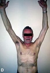 Prothèse inversée - Steve Brenn - Lausanne