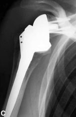 Prothèse inversée - Steve Brenn - Lausanne