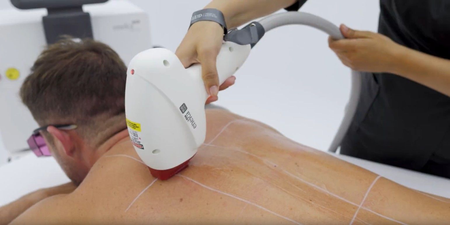 Una persona recibe un tratamiento de depilación láser en la espalda. Un técnico sostiene el dispositivo láser.