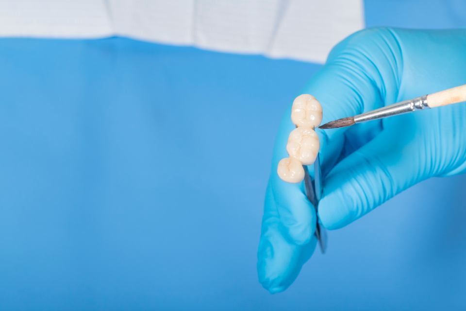 Vorstellung von Inlays und Teilkronen