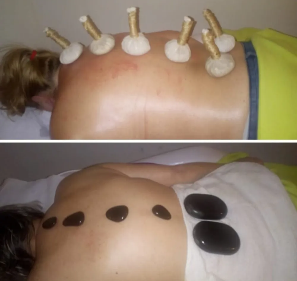 Fotografía en dos paneles de una espalda con marcas de terapia de ventosas y ventosas adheridas a lo largo de la columna vertebral.