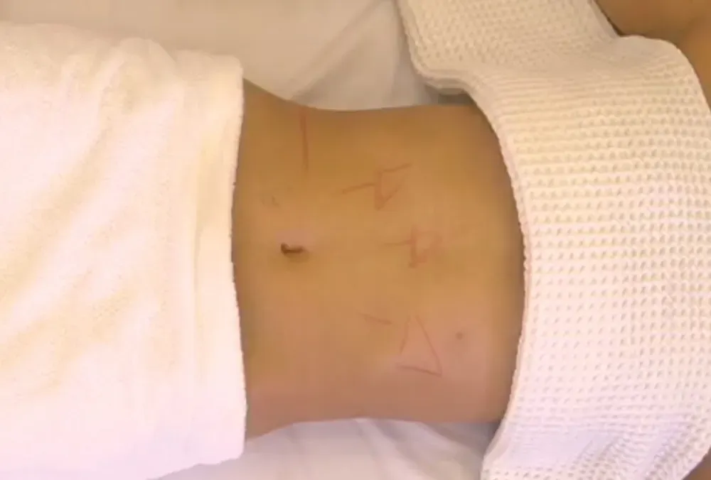 Abdomen con una pequeña incisión y leves marcas de bolígrafo, parcialmente cubierto por toallas blancas.