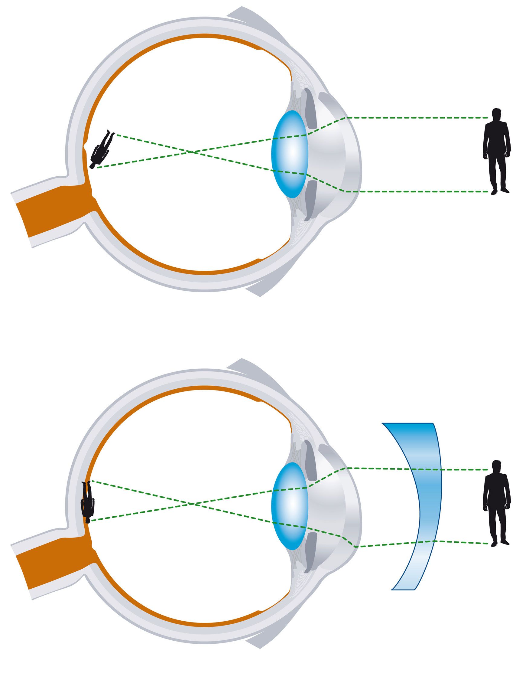 Schéma de l'œil montrant une vision normale en haut et une hypermétropie corrigée par une lentille bleue en bas.