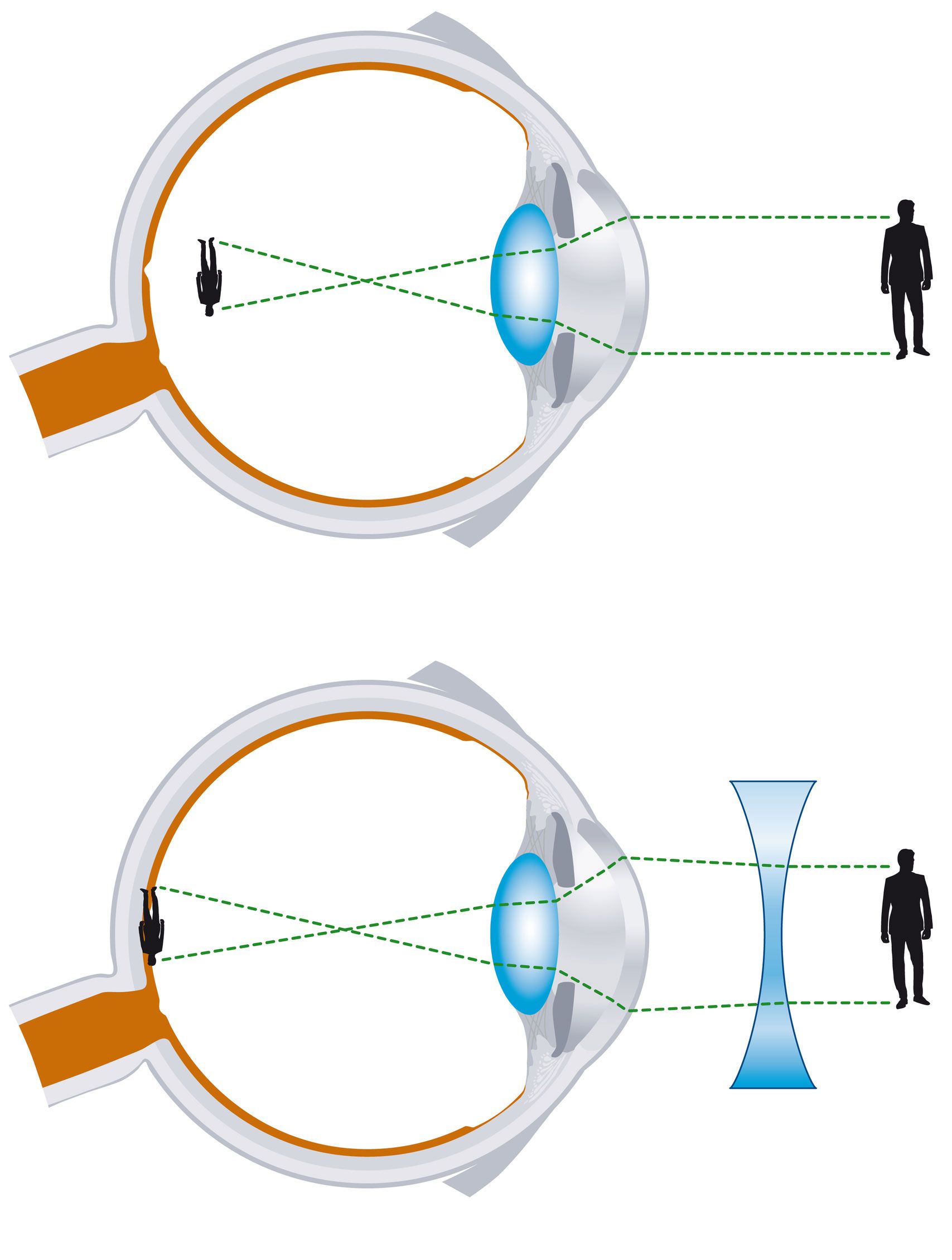Schéma de la mise au point de l'œil : vision normale en haut, corrigée par une lentille concave en dessous