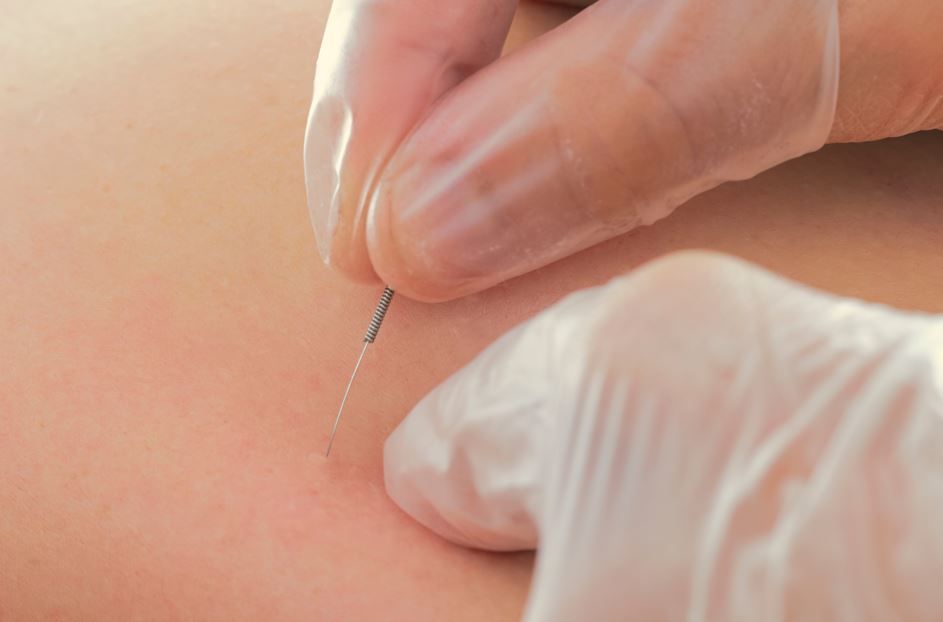 Mano enguantada que sostiene una aguja de acupuntura y la inserta en la piel.