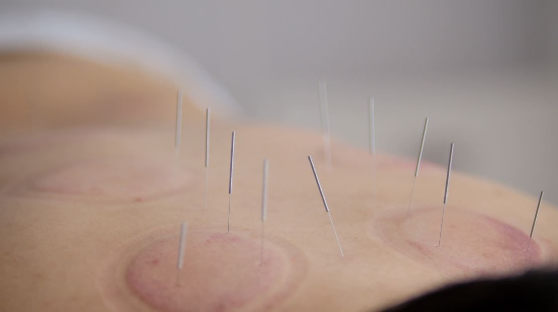 Espalda con agujas de acupuntura y marcas de ventosas en la espalda de una persona.