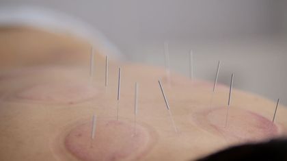 Espalda con agujas de acupuntura y marcas de ventosas en la espalda de una persona.