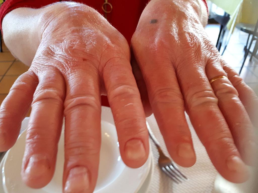 Traitement des brûlures - après séance