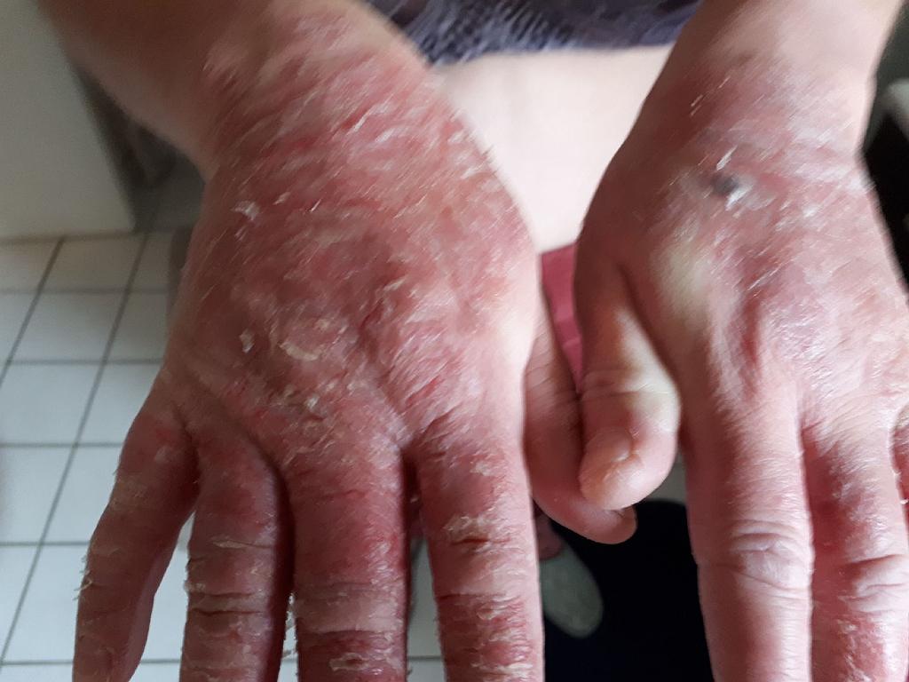 Traitement des brûlures - avant séance