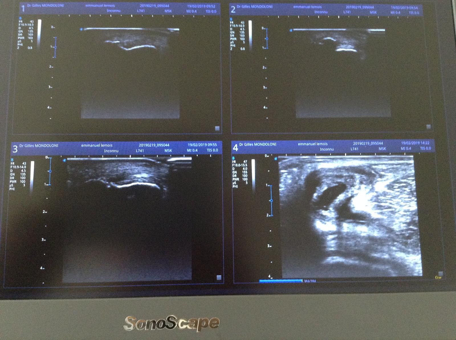 Échographie pendant injection