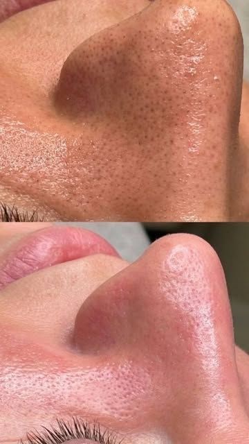 Comparación de una nariz antes y después del tratamiento. Arriba: Piel con poros visibles. Abajo: Piel más suave.