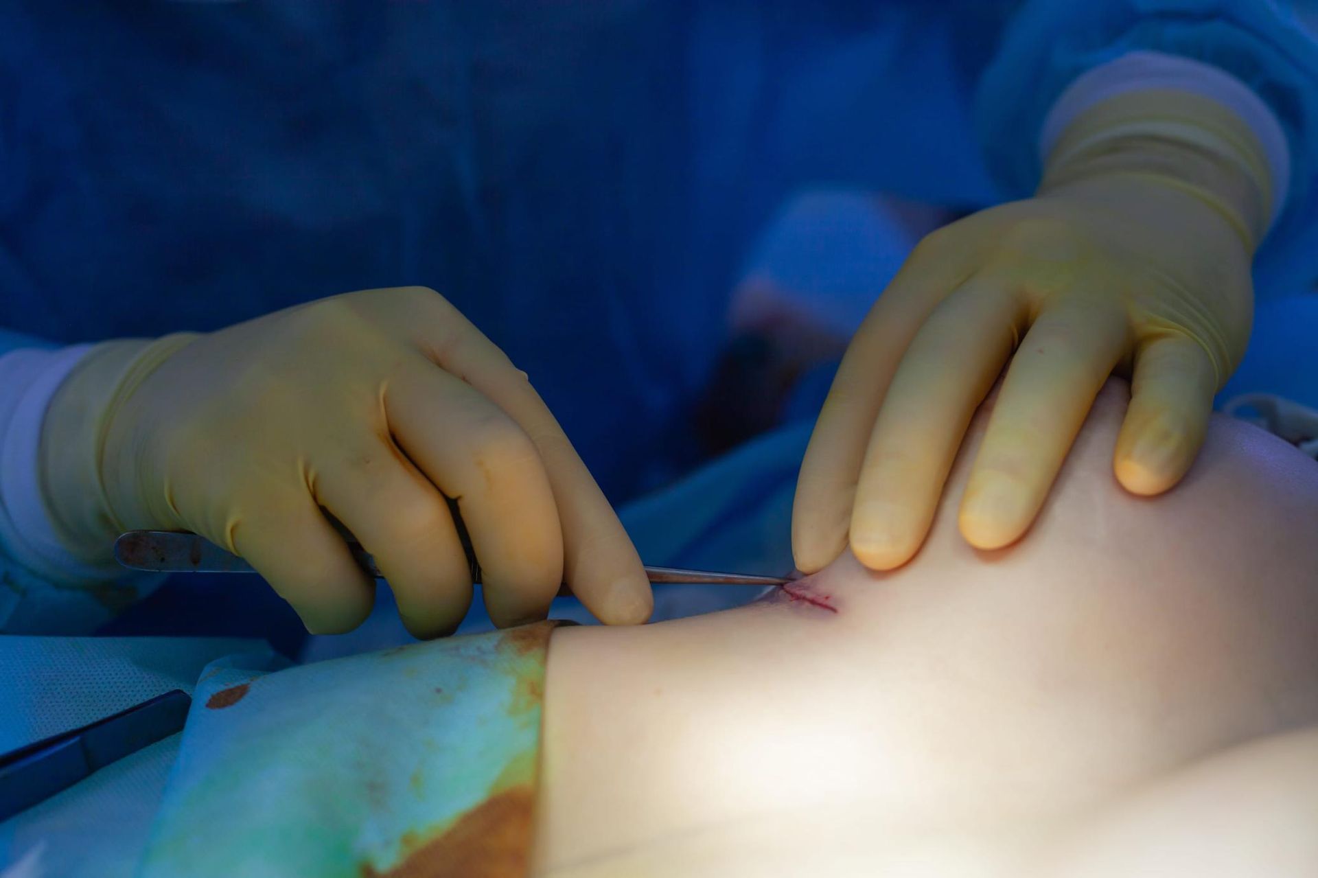 Manos enguantadas realizando una cirugía en el abdomen expuesto de un paciente bajo la brillante luz del quirófano.