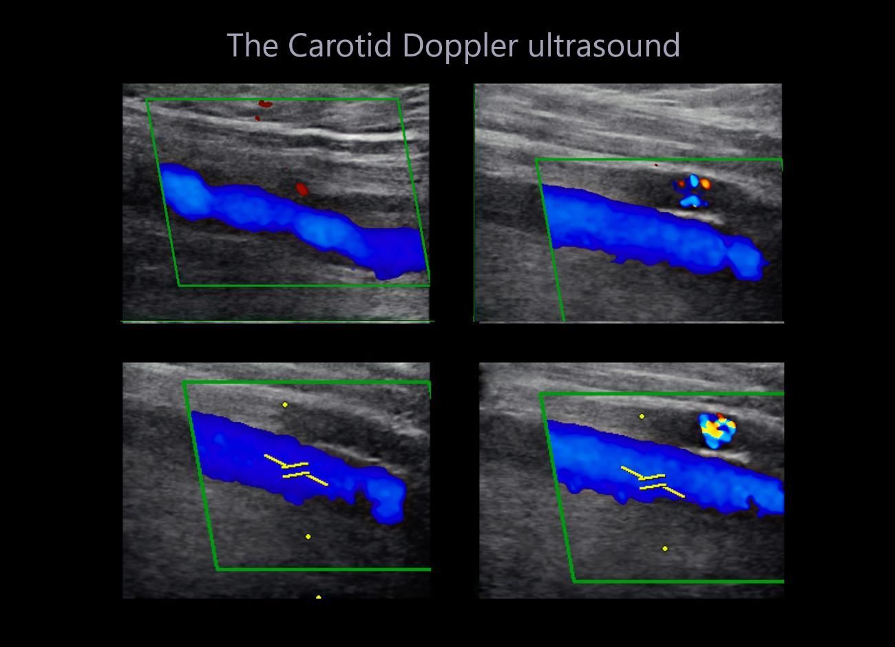 Ecografía Doppler carotídea con cuatro paneles de exploración vascular en azul y color.