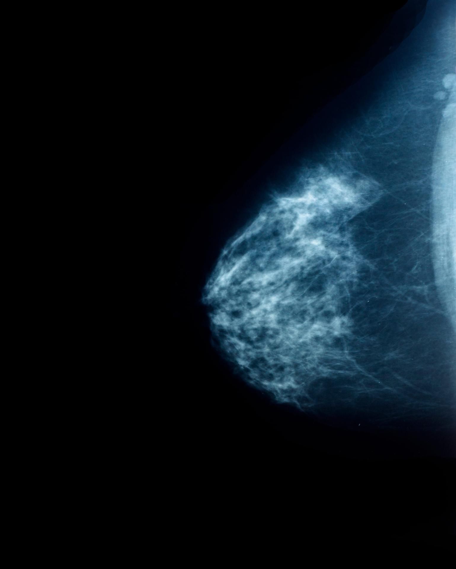 Mamografía en escala de grises en primer plano que muestra tejido mamario sobre un fondo negro.