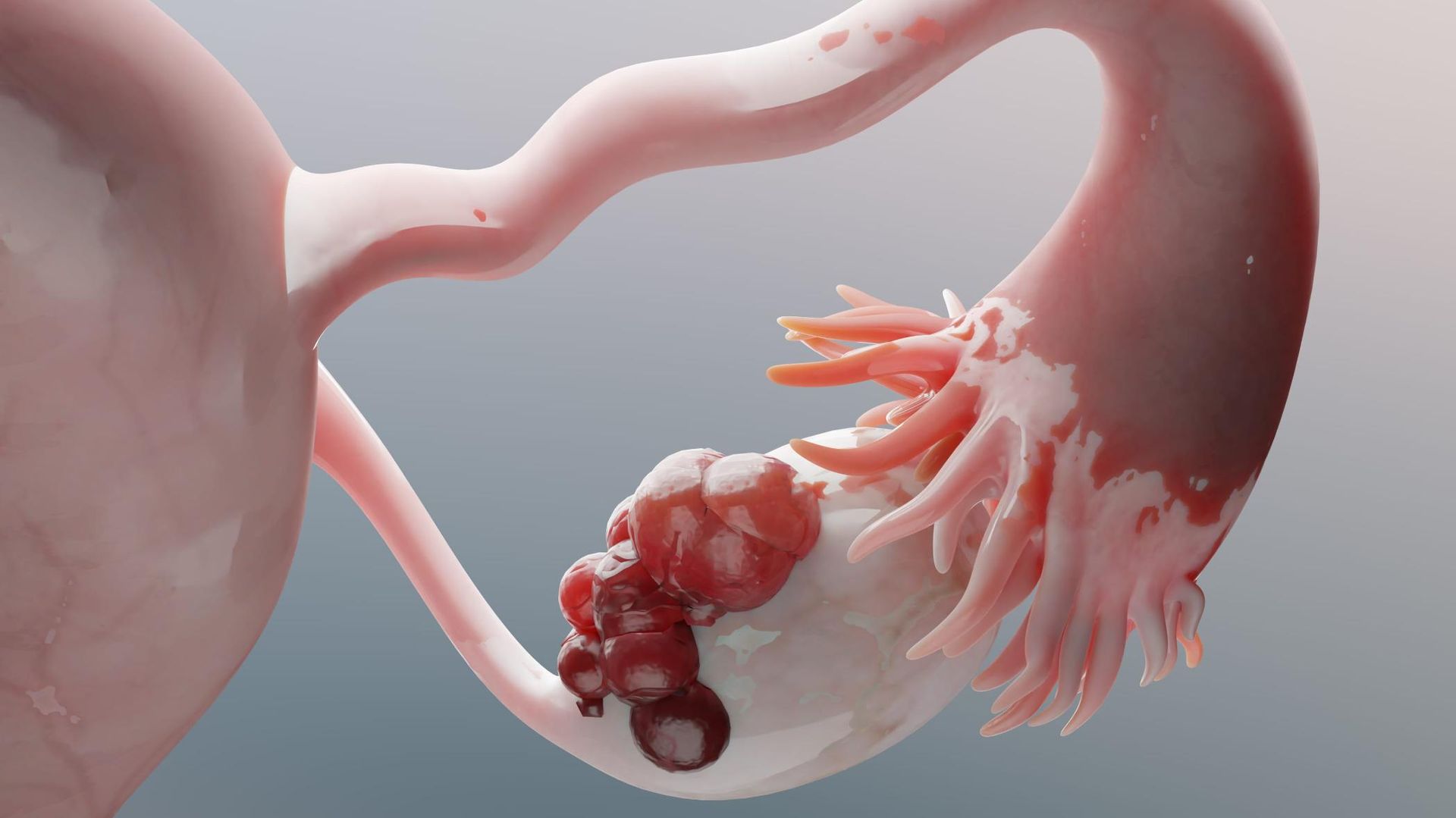 Ilustración médica en 3D de una masa en el ovario derecho.