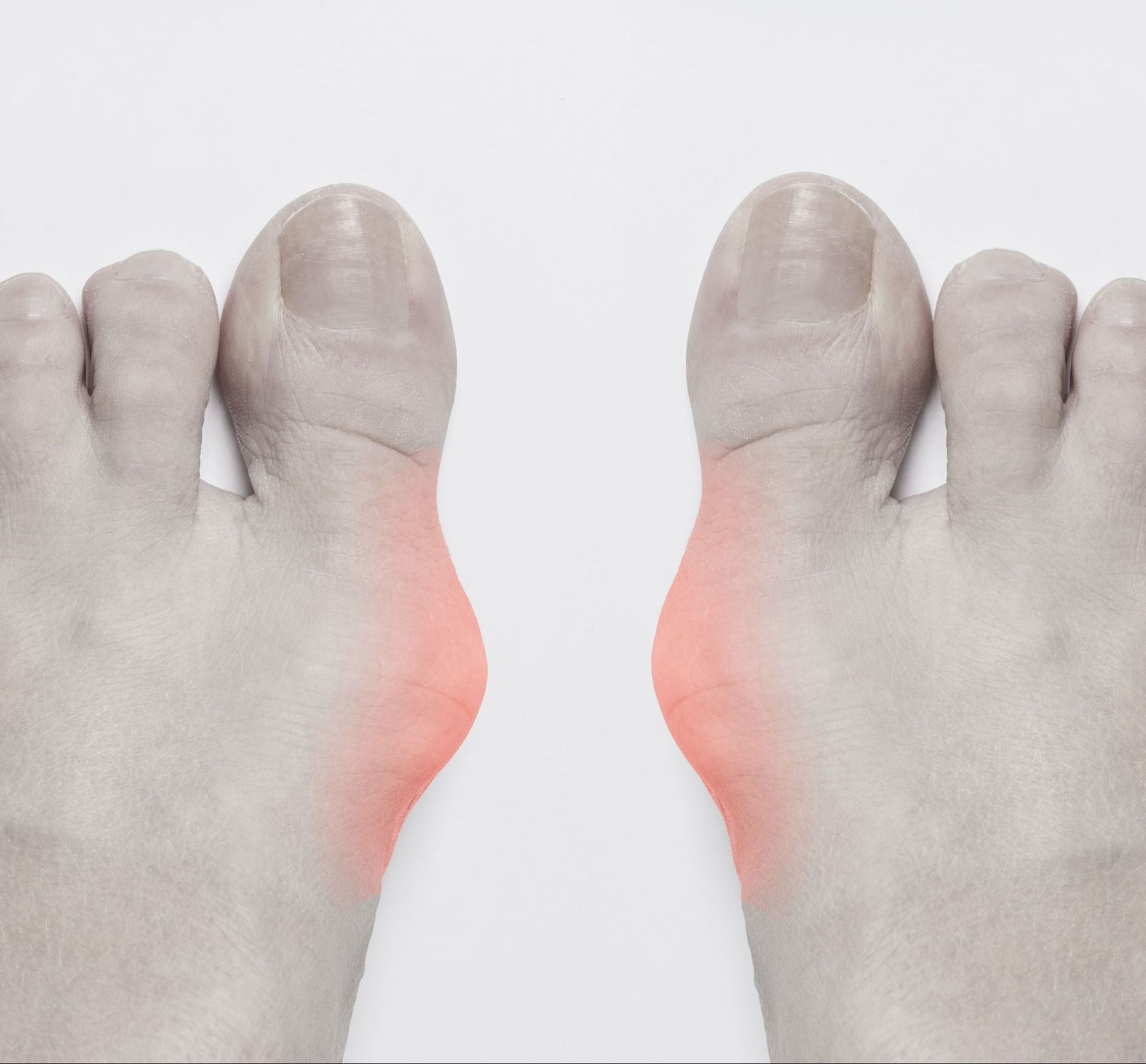 Hallux valgus - Dr Jan Huismans
