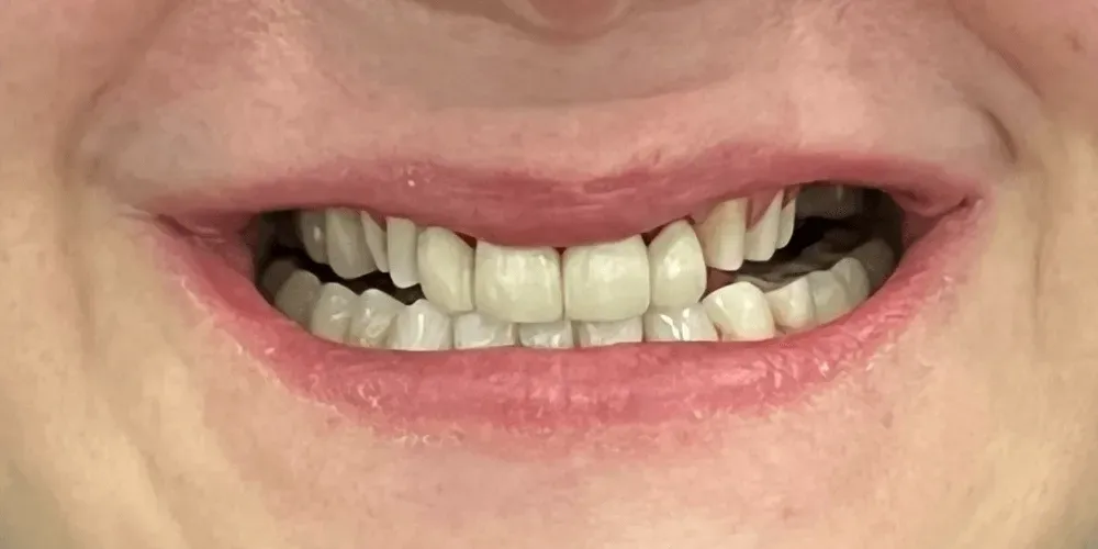 Primer plano de una boca sonriente que muestra los dientes con un espacio entre los dientes frontales.