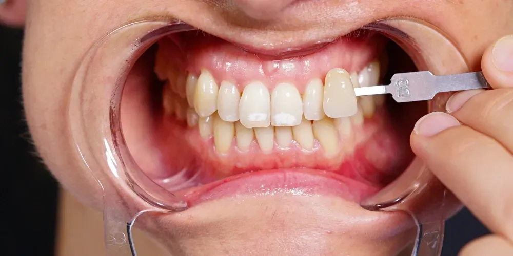 Herramienta para medir el color de los dientes frontales con la boca abierta.