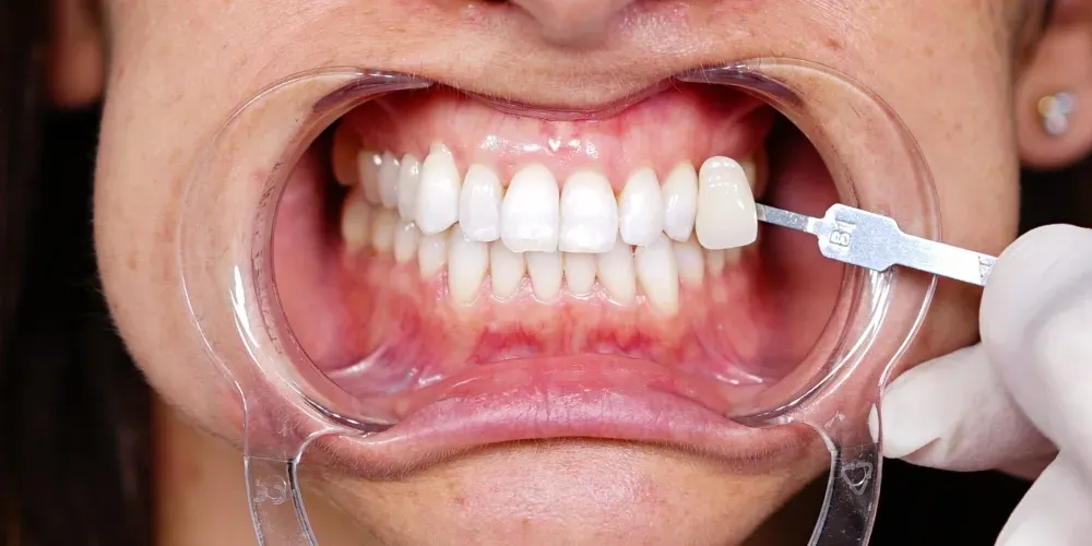 El dentista aplica gel blanqueador en los dientes superiores con un retractor de mejillas colocado.