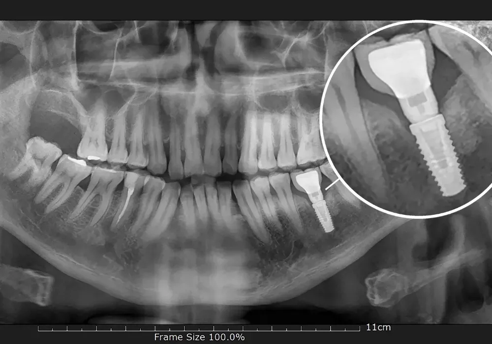 Radiografía panorámica dental con un recuadro ampliado que muestra un implante molar y una corona.