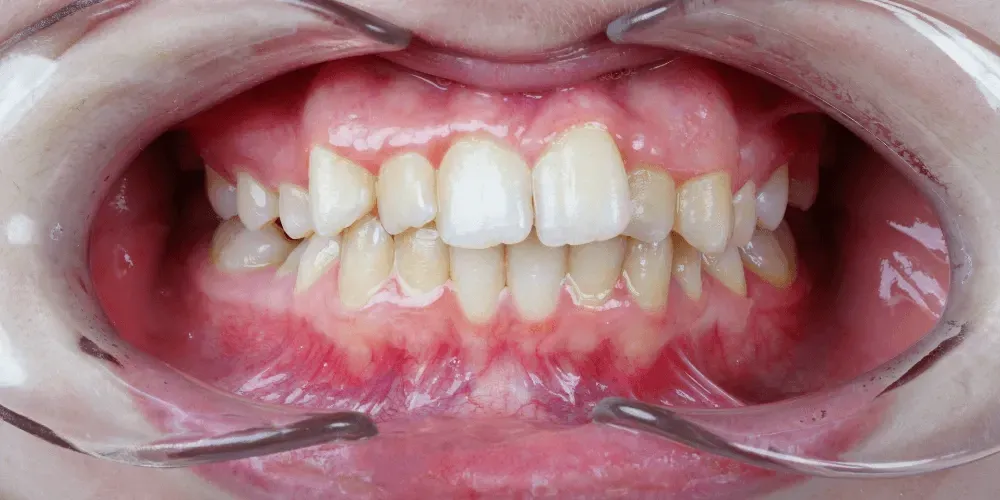 Primer plano de una boca con aparatos de ortodoncia y dientes apiñados, labios retraídos por instrumentos dentales.