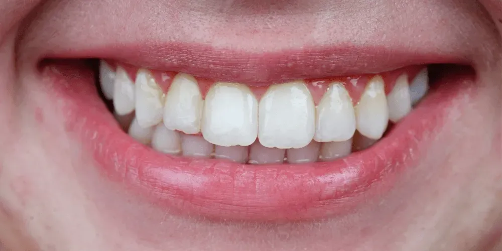 Primer plano de una boca sonriente con dientes blancos y labios rosados.