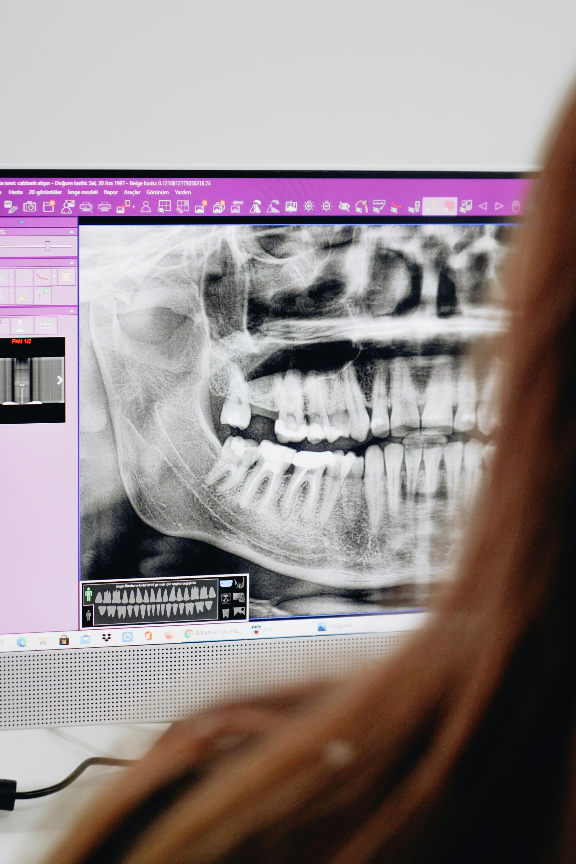 Una persona observa una radiografía panorámica dental mostrada en el monitor de una computadora.