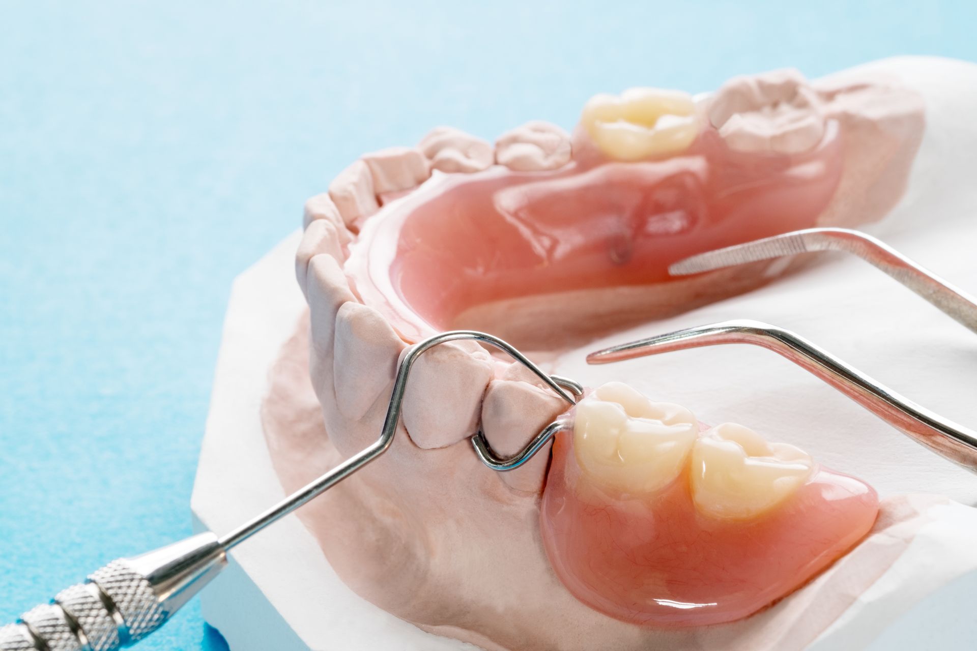 Porte-empreinte dentaire avec moule à dents roses et blanches maintenu par des outils métalliques