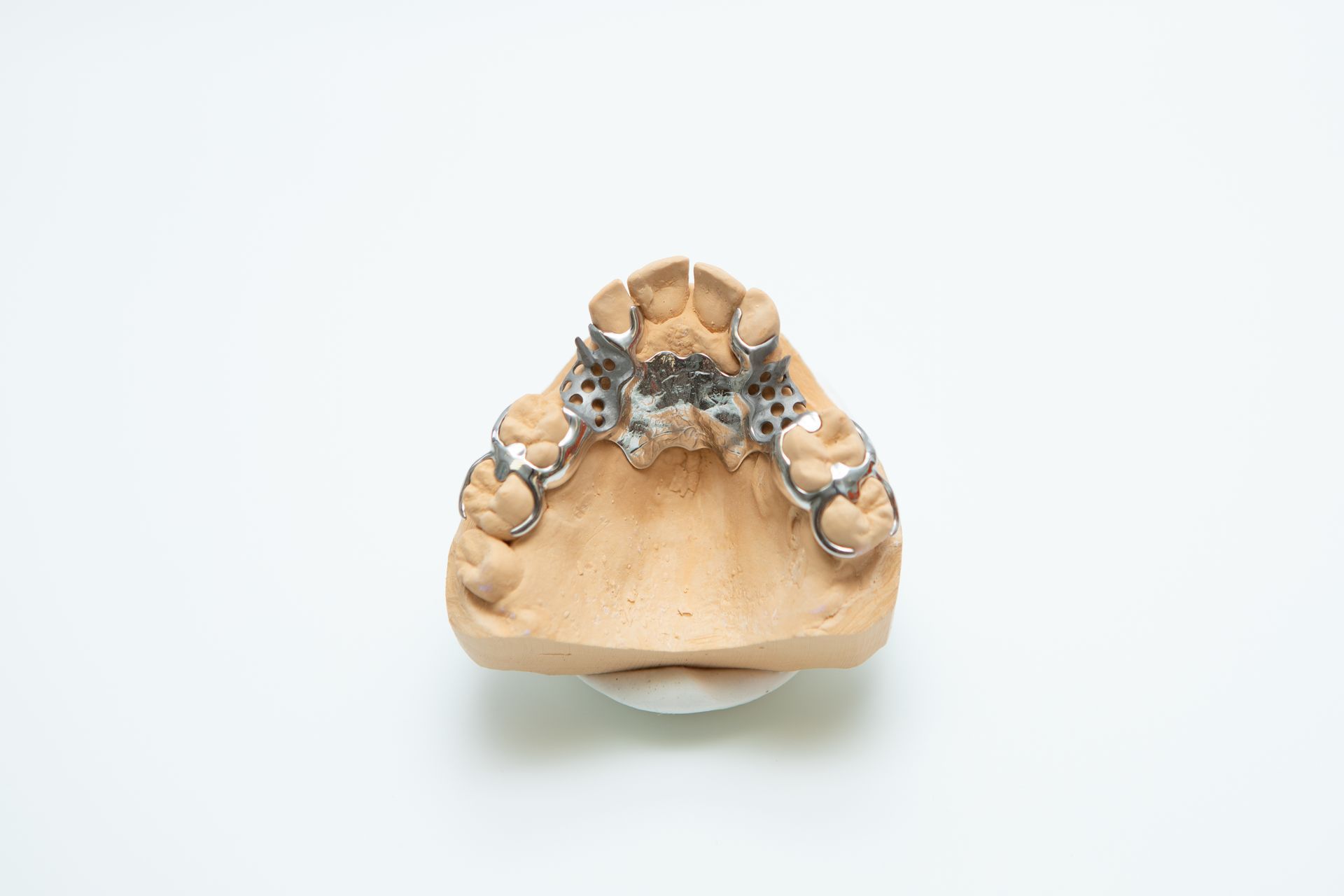 Modèle dentaire des dents supérieures avec appareil dentaire métallique sur un moule de mâchoire beige