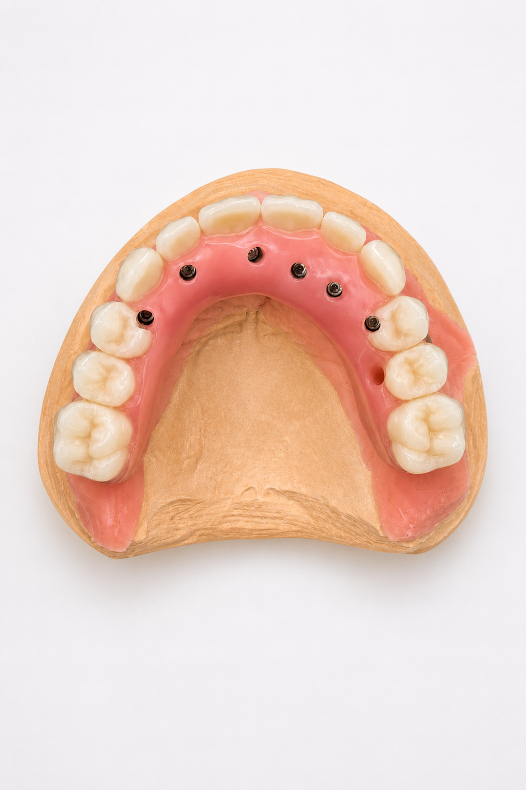 Porte-empreinte dentaire avec moule à dents roses et blanches maintenu par des outils métalliques