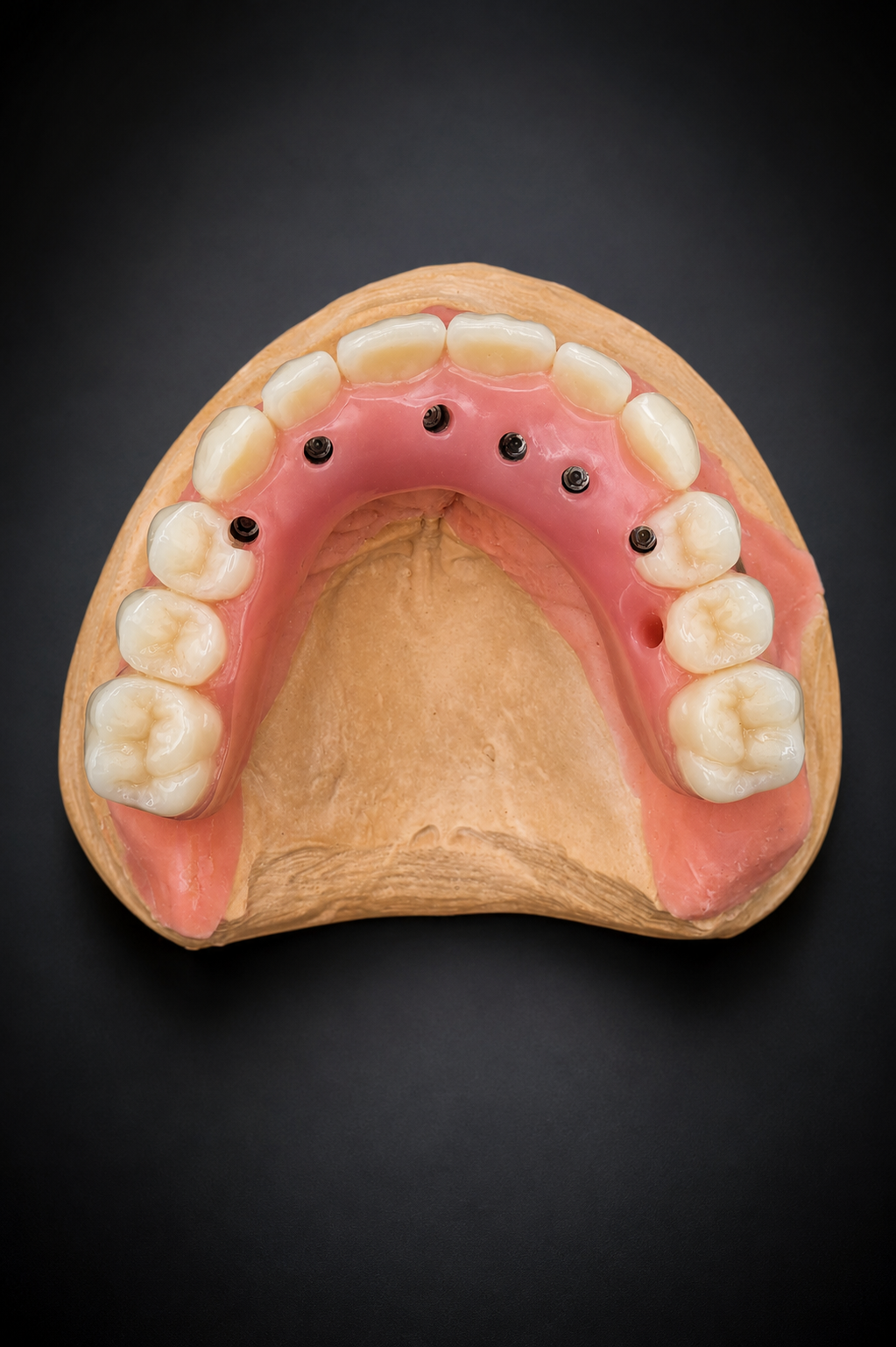 Porte-empreinte dentaire avec moule à dents roses et blanches maintenu par des outils métalliques