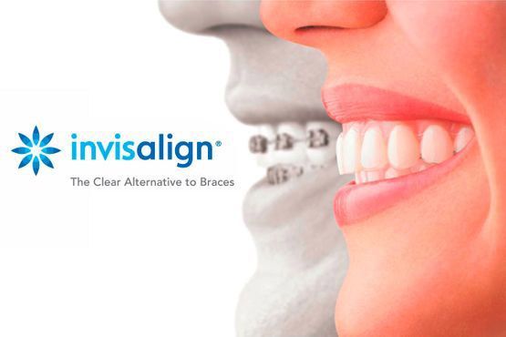 Anuncio de Invisalign con una boca sonriente con alineadores transparentes y el logotipo sobre un fondo blanco