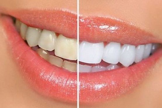 Primer plano de labios y dientes en pantalla dividida: dientes amarillentos a la izquierda y dientes de un blanco radiante a la derecha.