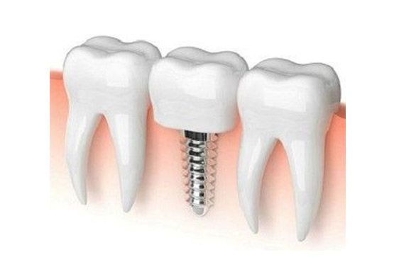 Ilustración de un implante dental entre dos dientes blancos, con encía rosada