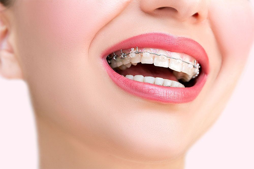 Primer plano de una sonrisa con brackets transparentes en los dientes blancos y pintalabios rosa