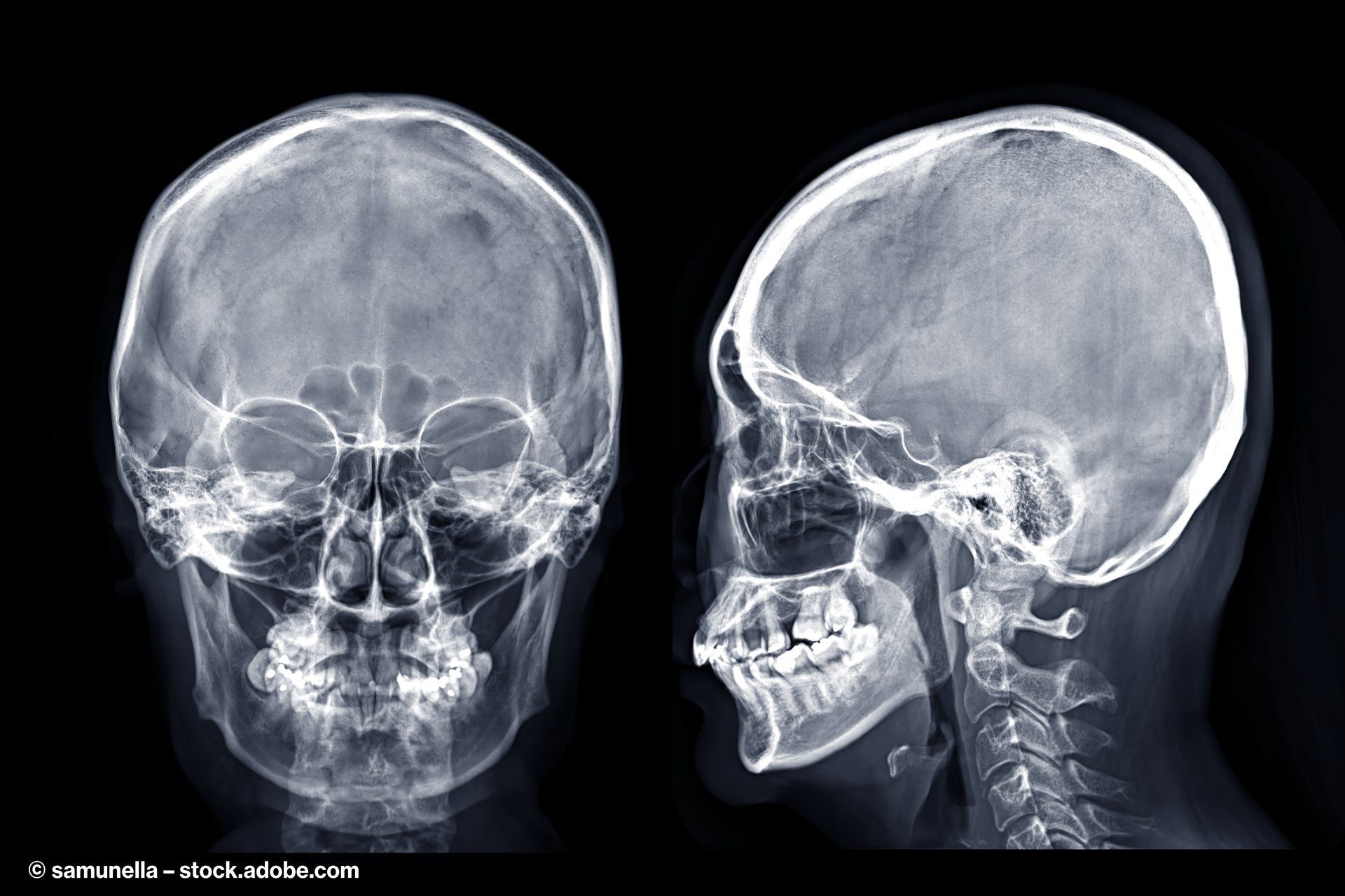Röntgenbild eines Kopfs von Vorne und von der Seite