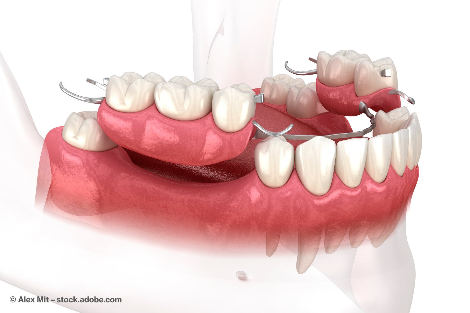 Grafik eines Zahnersatzes