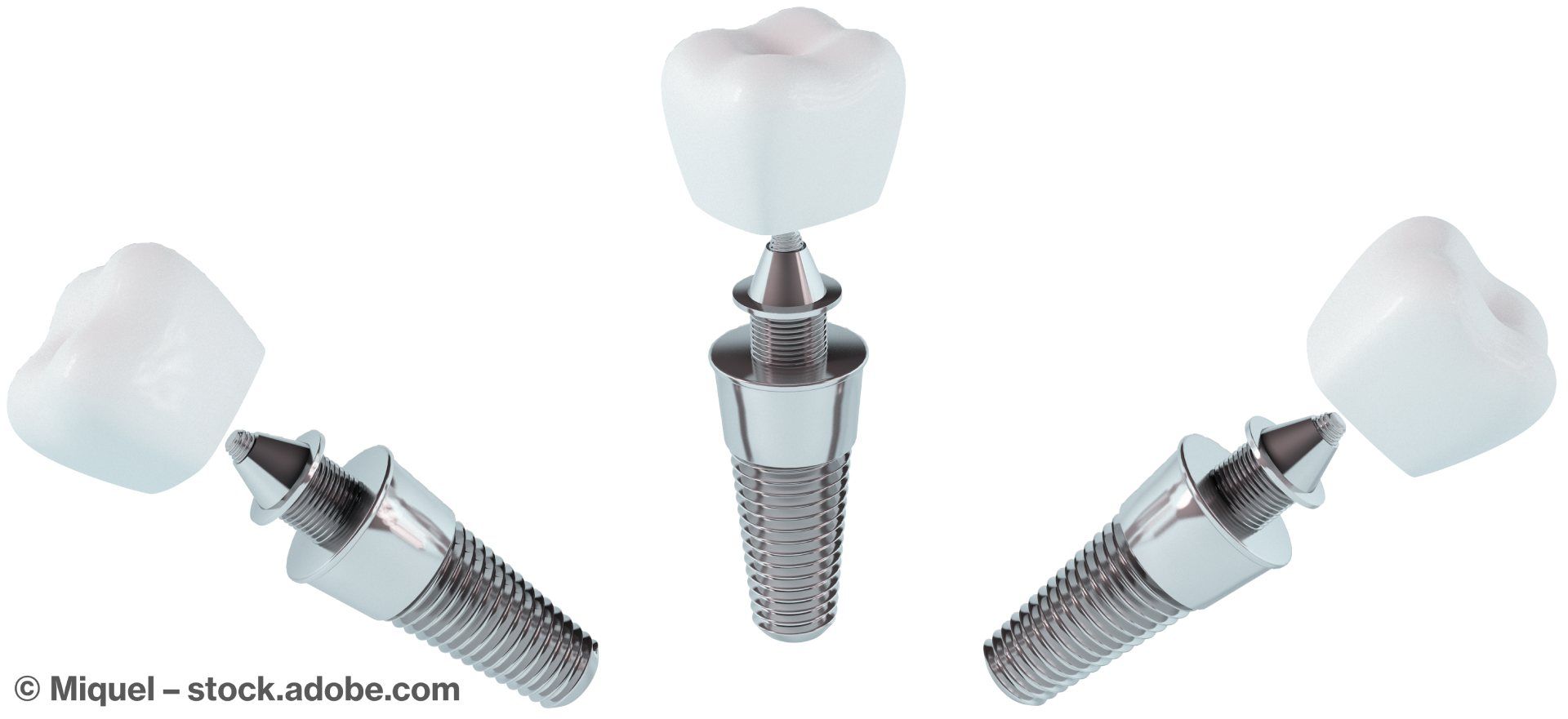 Grafik von Zahnimplantaten