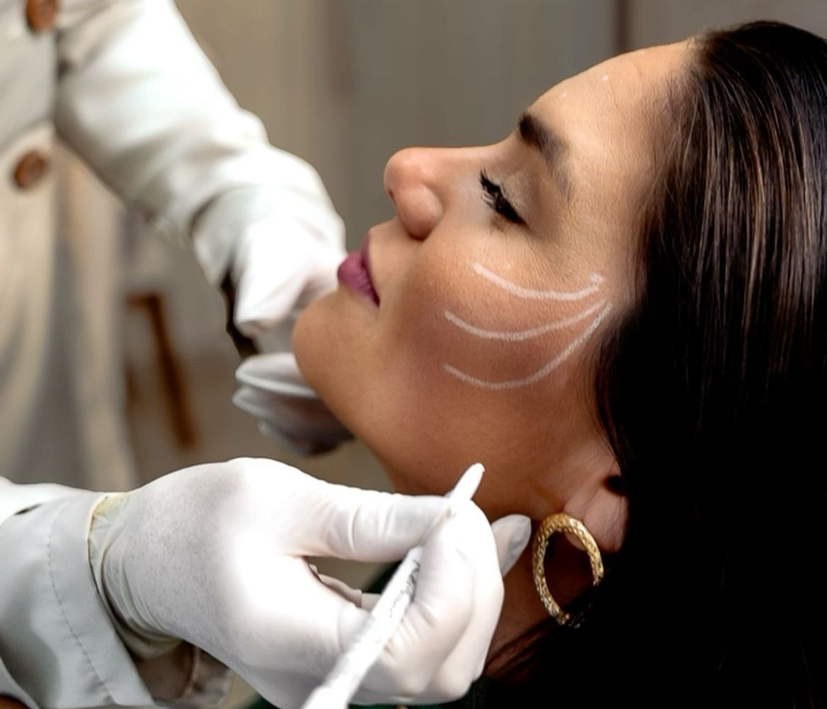 Visage de femme avec des lignes blanches marquées pour une intervention esthétique ; mains gantées tenant un stylo près de la joue.