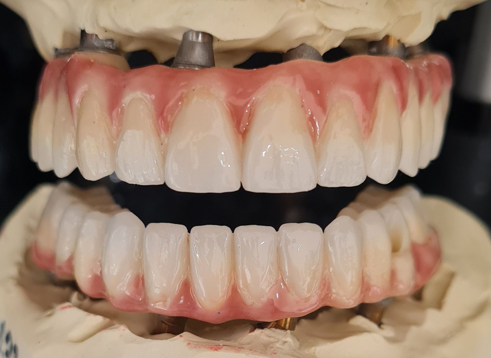 Eine Nahaufnahme einer Vollprothese auf einem Modell.