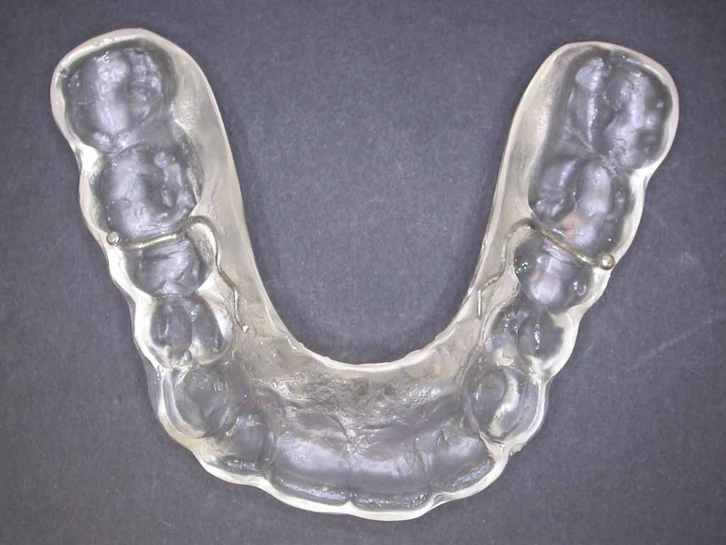 Michiganschiene Knirscherschiene - Daniel Wirz Zahnprothetik - Zürich
