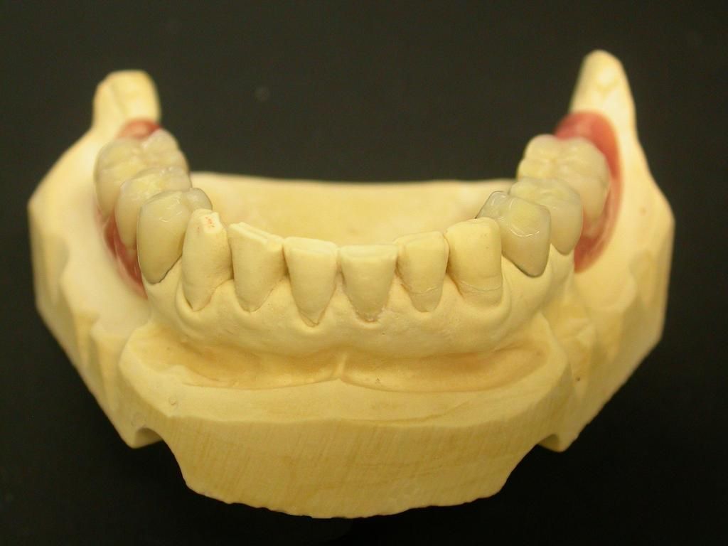 Unterkiefer Druckknopfprothese - Daniel Wirz Zahnprothetik - Zürich