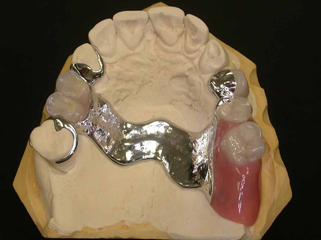 Oberkiefer Teilprothese Modellgussprothese - Daniel Wirz Zahnprothetik