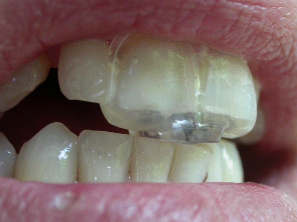 NTI-tss - Aufbissschiene - Daniel Wirz - Zahnprothetiker - Zürich