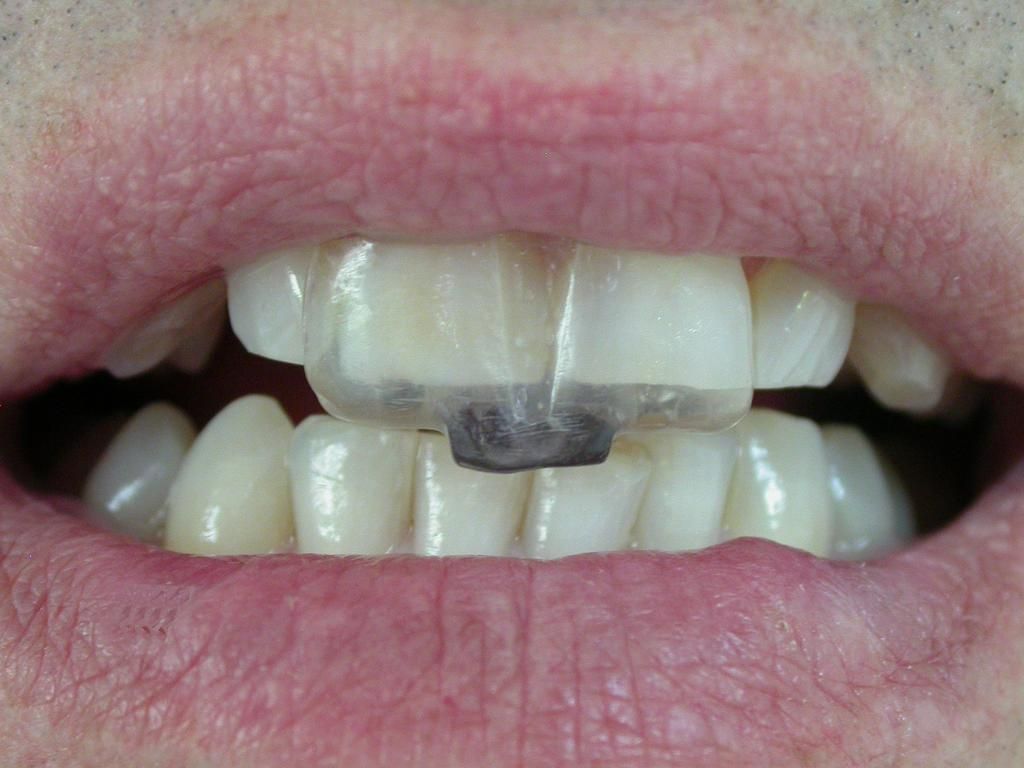 NTI-tss - Aufbissschiene - Daniel Wirz - Zahnprothetiker - Zürich