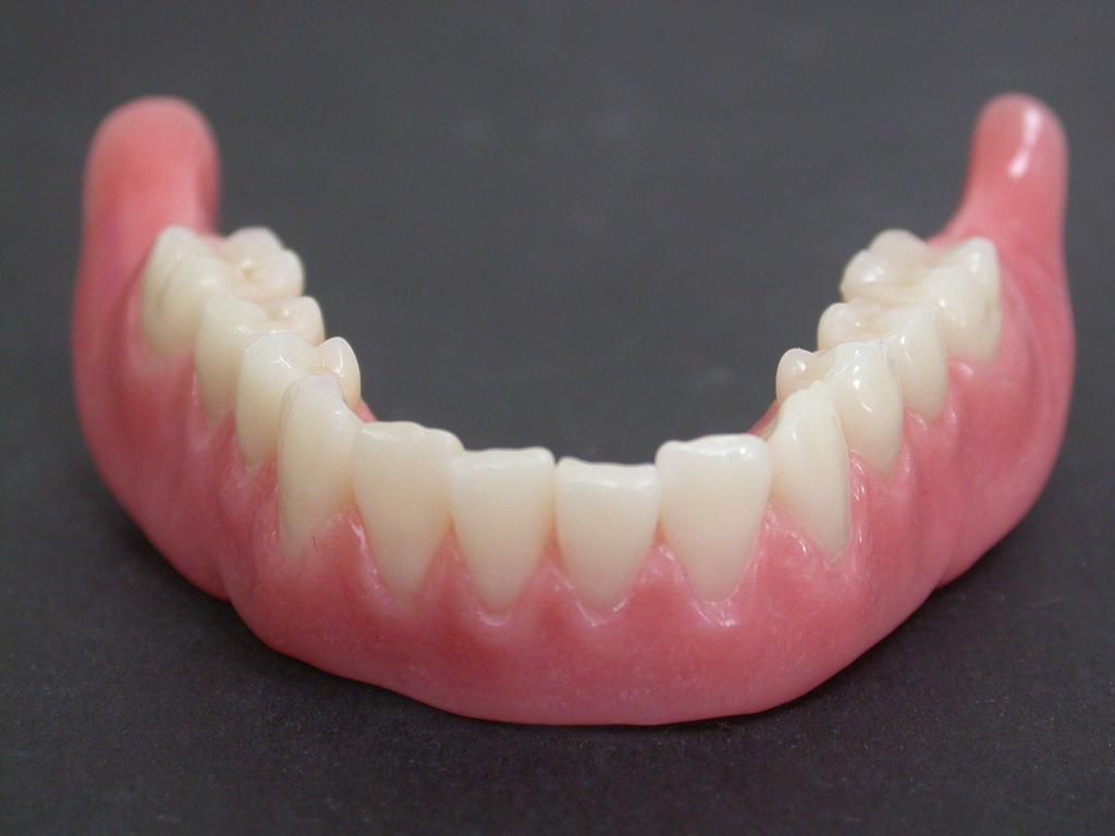 Unterkiefer Totalprothese - Daniel Wirz Zahnprothetik - Zürich