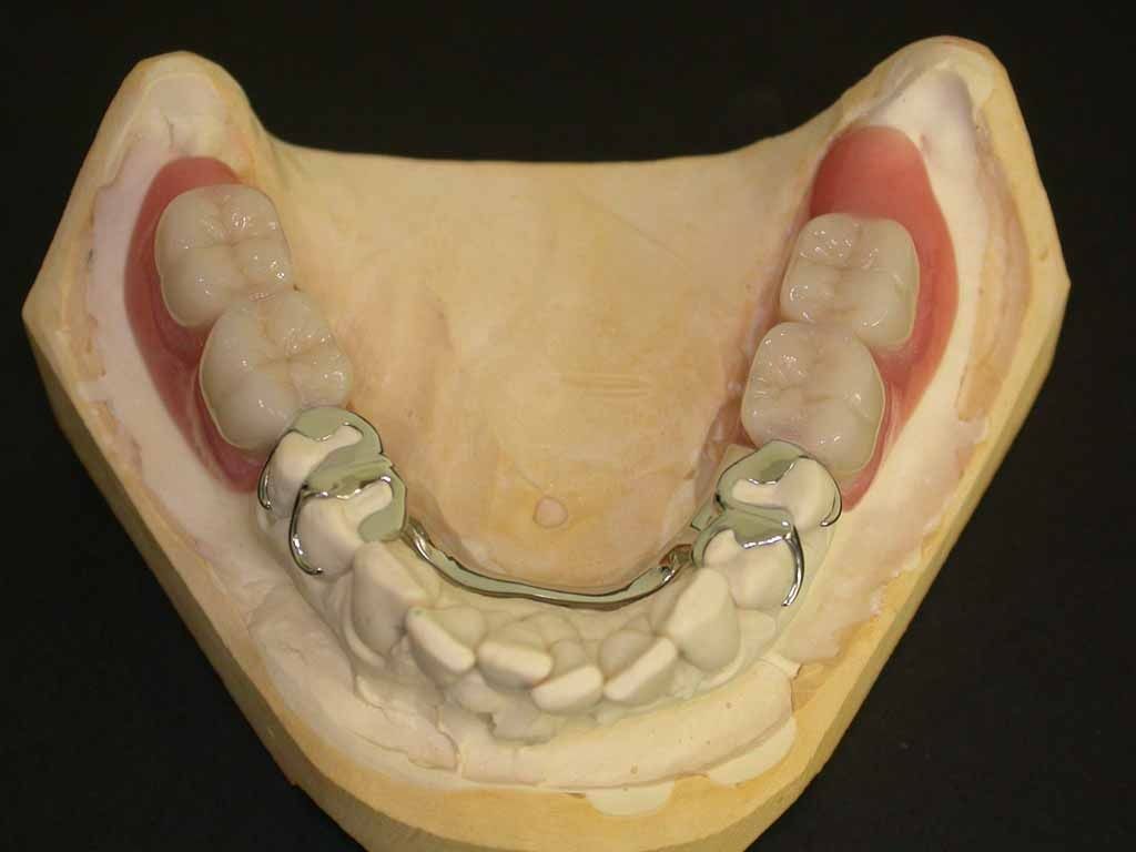 Unterkiefer Teilprothese Modellgussprothese -Daniel Wirz Zahnprothetik